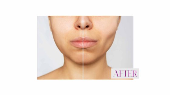 buccal fat removal amaryllis clinic plastic surgery abu dhabi 2