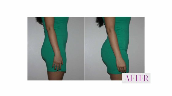 brazilian butt lift amaryllis clinic plastic surgery abu dhabi 1