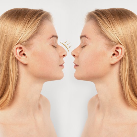 rhinoplasty amaryllis clinic plastic surgery german plastic surgeon in abu dhabi 5