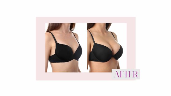 breast surgery amaryllis clinic plastic surgery abu dhabi before and after