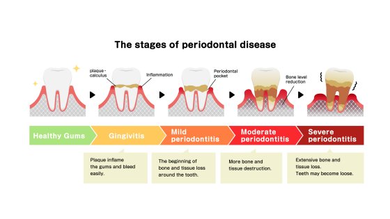 gum and periodontal treatment amaryllis german clinic best dental clinic in abu dhabi 0