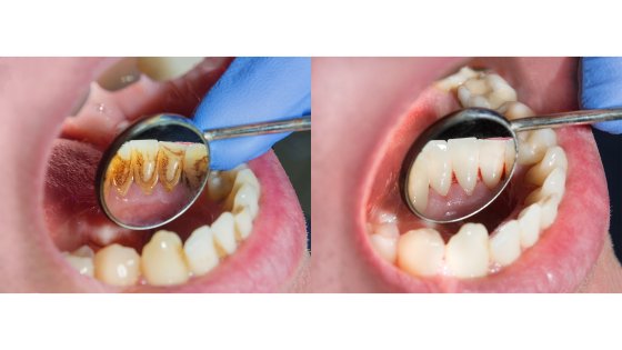prevention professional prophylaxis design best dental clinic in abu dhabi 1