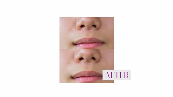 keloid treatment amaryllis clinic plastic surgery dr. chris reuter german plastic surgeon in abu dhabi