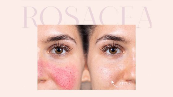 rosacea treatment amaryllis clinic plastic surgery dr. chris reuter german plastic surgeon in abu dhabi 1
