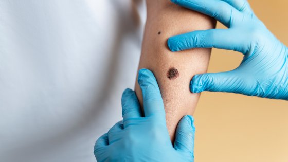 skin cancer amaryllis clinic plastic surgery dr. chris reuter german plastic surgeon in abu dhabi 1