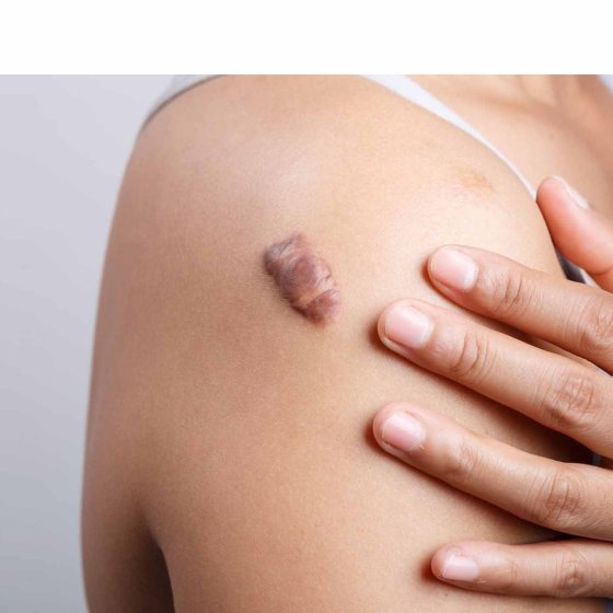 keloid treatment amaryllis clinic plastic surgery dr. chris reuter german plastic surgeon in abu dhabi 1699339815