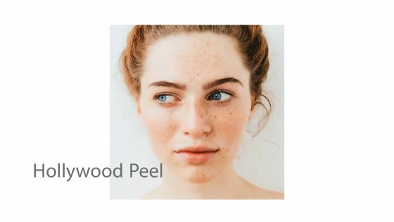 carbon peeling carbon laser peel or q switch laser treatment amaryllis clinic plastic surgery abu dhabi 8