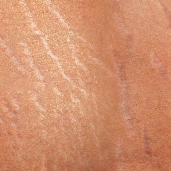 stretch mark removal amaryllis clinic plastic surgery dr. chris reuter german plastic surgeon in abu dhabi 2